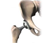 medical device hip replacement medical device hip replacement using materials science