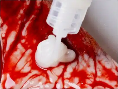 A close-up of ChitoLytic cream being applied to human tissue for wound healing.