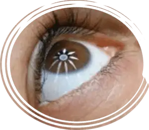 Clear eye with ChitoLytic: Innovative eye health treatment for better vision and comfort.
